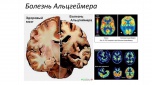 Профилактика болезни Альцгеймера